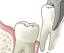 Extraction simple des dents de sagesse