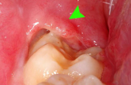 Pag-aayos ng mga ngipin ng karunungan sa bulsa ng gingival