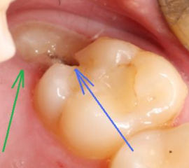 Rétention des dents de sagesse