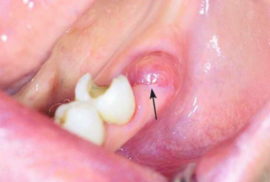 Malubhang alveolitis