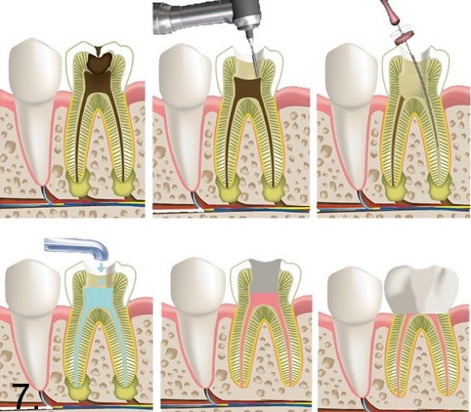 Étapes du traitement de la pulpite