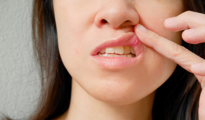 A woman has stomatitis in her mouth