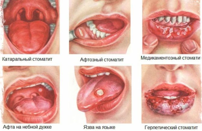 Mga uri ng Stomatitis