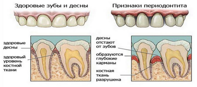 Panlabas na mga palatandaan ng periodontitis