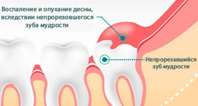 Inflammation et gonflement des gencives dus à une dent de sagesse incassable