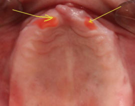 Prosthesis ng oral mucosa