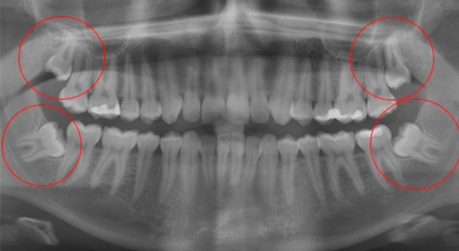 Orthopantomogram zub moudrosti